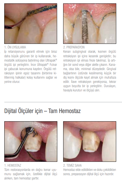 Ultradent Fischer s Ultrapak Packer Retraksiyon pi Fulvar 